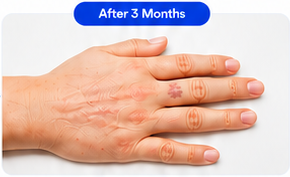 Recovery result after three months