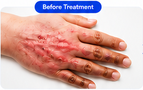 Burn injury before treatment